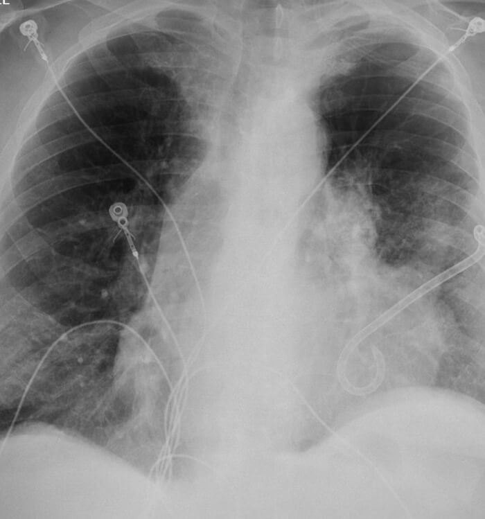 Pneumothorax scan image