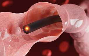 3D rendering of an endoscope inside colonoscopy showing colon polyp removal