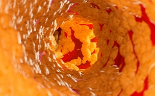 Illustration of a fat clogged artery