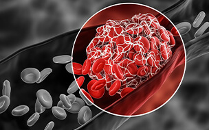 3D rendering illustration of a blood clot blocking the red blood cells stream within an artery