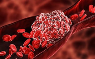 illustration of blood clot