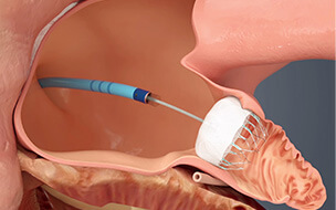Next-Generation Devices for AFib Offer an Alternative to Blood Thinners 