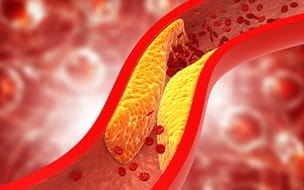 Is Coronary Calcium Scoring Right for You? 4 Things to Know