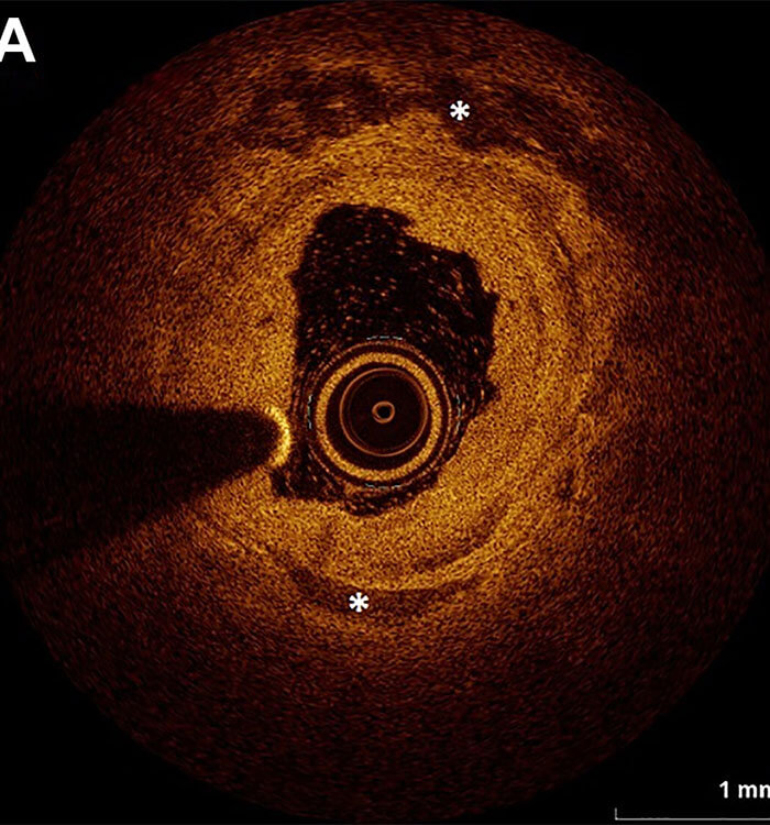 Example of intravascular imaging via (A) optical coherence tomography, published J Am Coll Cardiol Intv. Jan 17, 2024. Epublished DOI: 10.1016/j.jcin.2023.11.040