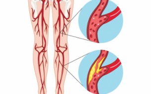 What Everyone Should Know about Peripheral Artery Disease PAD