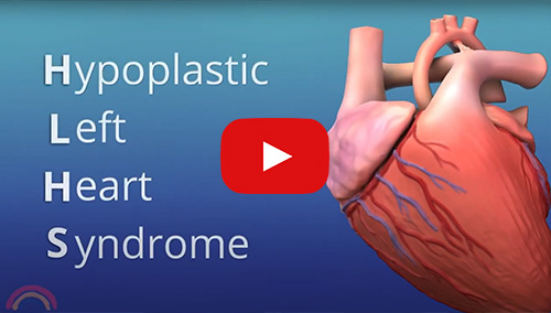 Click to watch the Hypoplastic Left Heart Syndrome video