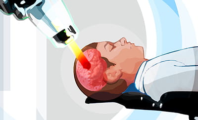 UH Seidman Cancer Center - Service - Proton Therapy - laser into brain no tumor