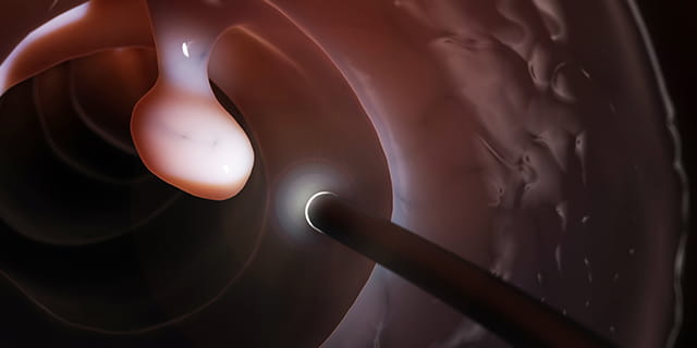 A colonoscope shines a light on a polyp inside a colon