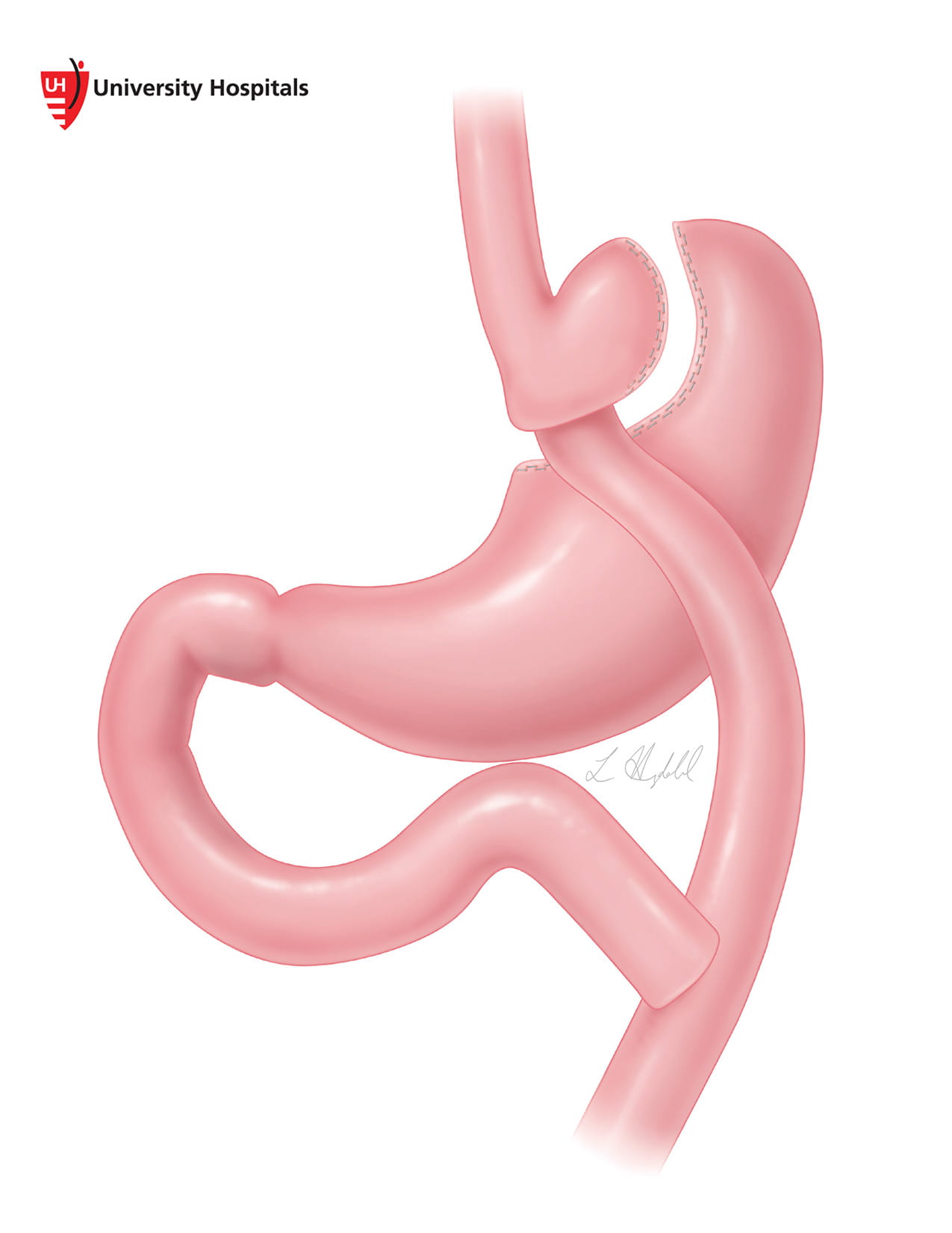 Illustration of gastric bypass by L. Hugdahl