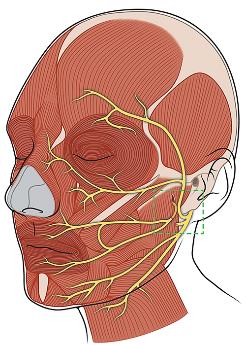 Diagram of a Masseter Nerve Transfer