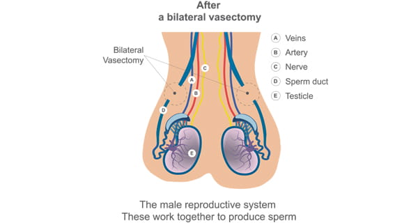 Vasectomy Diagram