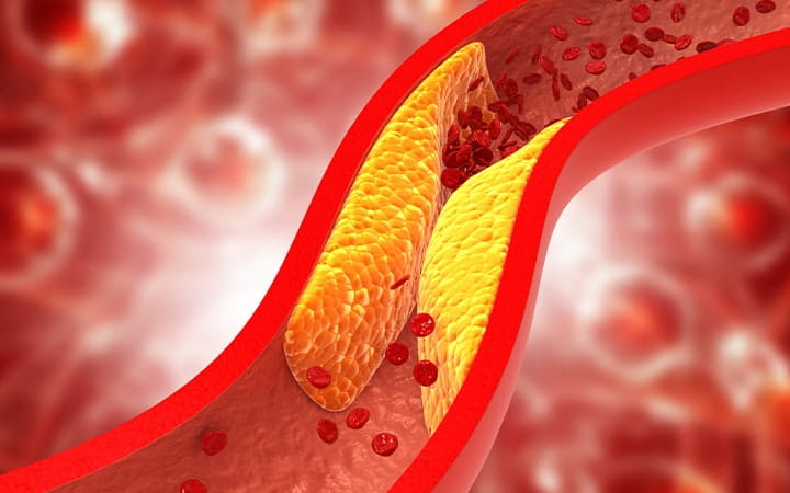 Illustration of cholesterol plaque in clogged artery
