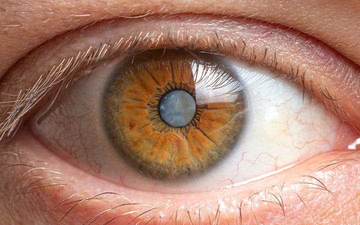Close-up image of a human eye depicting a cataract clouding of the lens