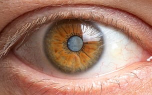 Close-up image of a human eye depicting a cataract clouding of the lens