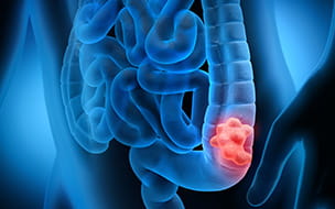 How To Stop Colon Cancer in Its Tracks