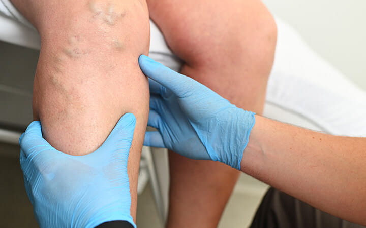 A hlebologist examines a patient with varicose veins