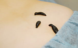 How Leeches Can Save Lives And Limbs for Some Patients
