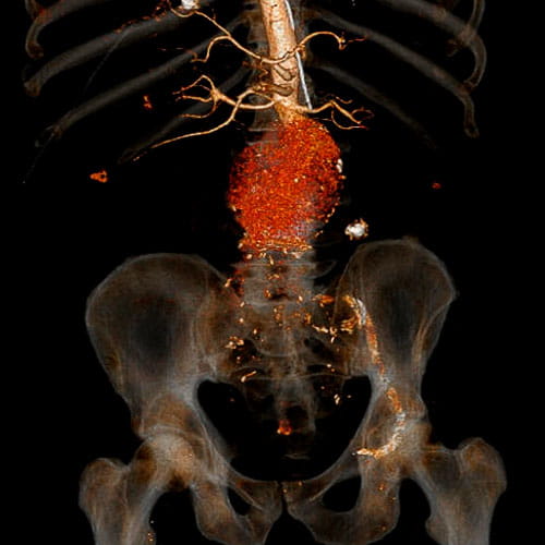 Image of aortic rupture