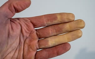 white fingers from Raynaud's syndrome
