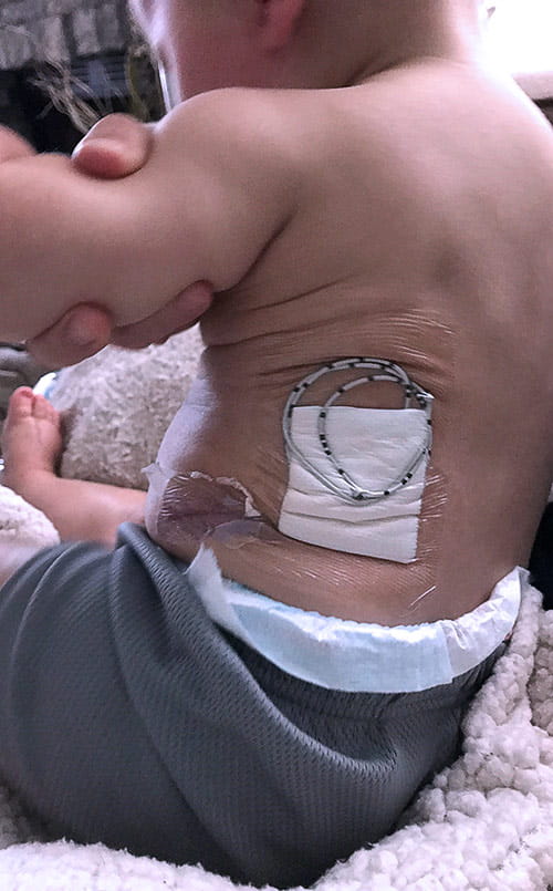 Infant Easton bandaged after urological procedure