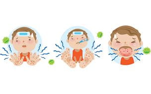 Illustration of a child displaying symptoms of hand, foot, and mouth disease