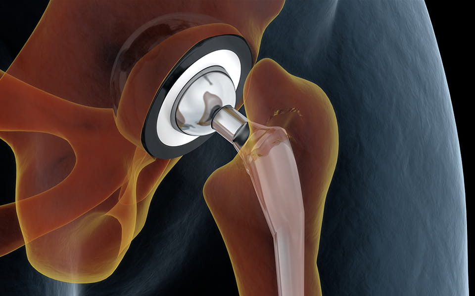Hip and Knee Joint Replacement Surgery: How Is It Done