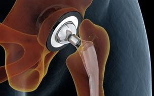 Illustration of joint replacement