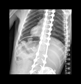 X-ray of Paige's spine after surgery