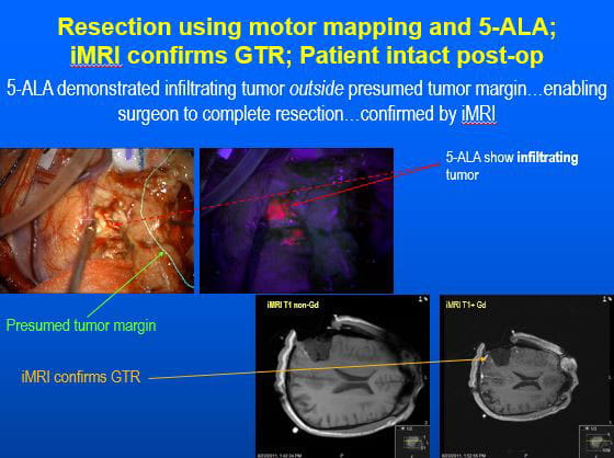 Resection using motor-mapping and 5-ALA