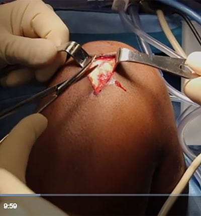 ACL reconstruction image from Video Journal