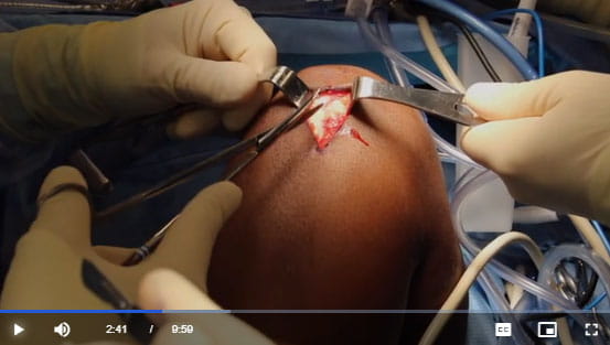 ACL reconstruction Video Journal of Sports Medicine