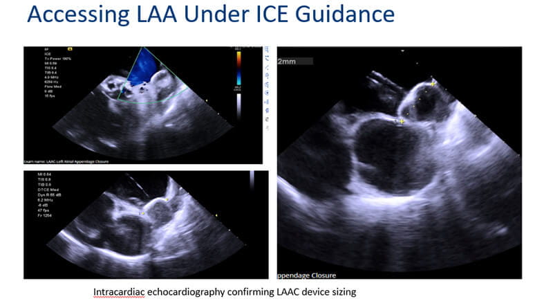Intracardiac echo during procedure with selected device in place