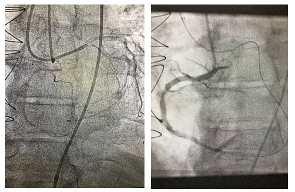Before and after stent implantation of RCA