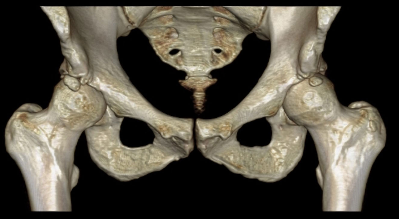 Caption: Image depicts Cam impingement with resultant acetabular rim fractures.