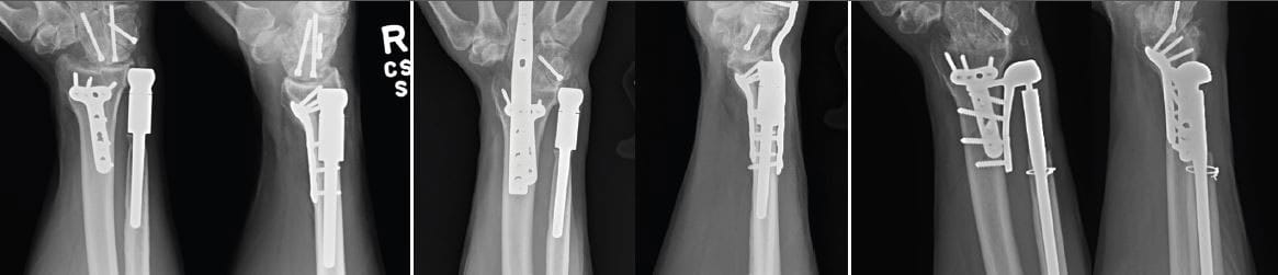 Constrained Arthroplasty of Distal Radioulnar Joint After Sever Fracture