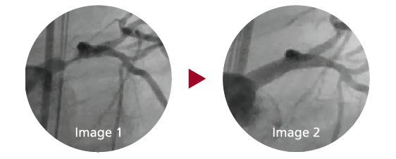Left: Angiogram image before treatment; Right: Result after a single drug-eluting stent