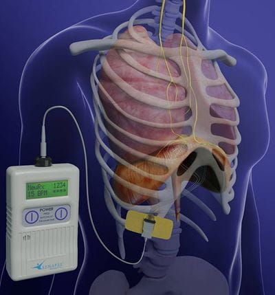 Expanding Diaphragm Respiratory Pacing