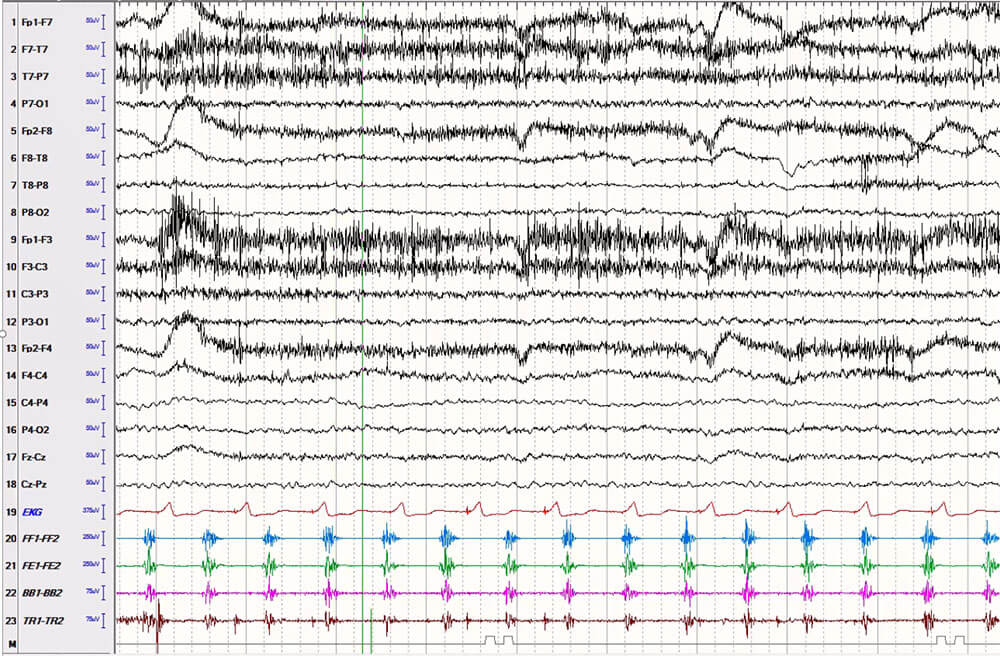 EEG-sEMG recording of a patient with right hand clonic seizure. The EEG (first 18 channels) does not show any discernible seizure pattern, but the sEMG channels (channel #20-23) show clear brief tetanic contractions, alternating with brief silent periods, synchronized between flexor and extensor muscle groups, consistent with a cortical/epileptic origin of the clonic movement. This sample shows the value of sEMG recording in analyzing patients with twitching movements, concerning for clonic seizures.I understand some photos were taken but may not have sufficient resolution