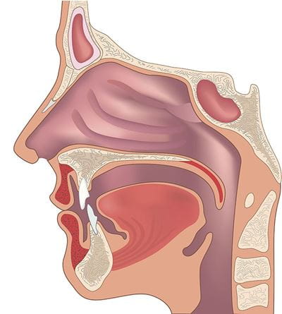 The Enigma of Enlarged Vestibular Aqueduct Syndrome