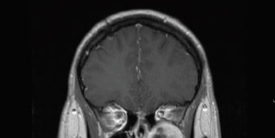 Coronal T1 post contrast MRI demonstrating the left sided schwannoma centered within the pterygopalatine fossa. Inferior orbital compression is demonstrated.