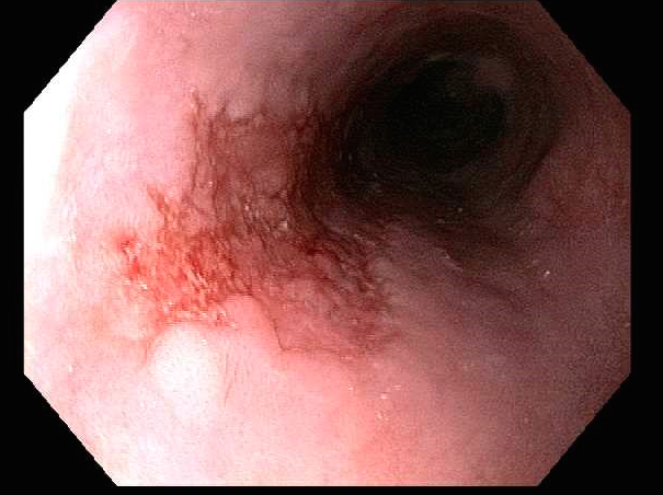 Esophagus with early squamous cell cancer, shown with high-definition white light