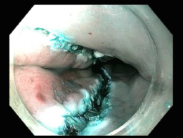 Initial circumferential incision