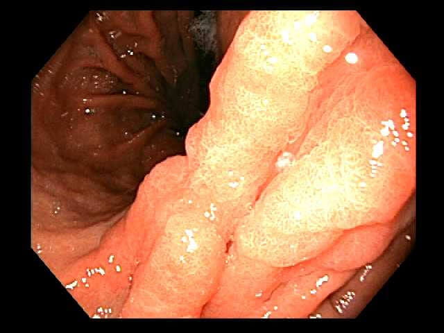 Microscopic view of an early gastric cancer