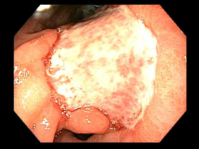 Follow up endoscopy after submucosal dissection site at 3 weeks. 
