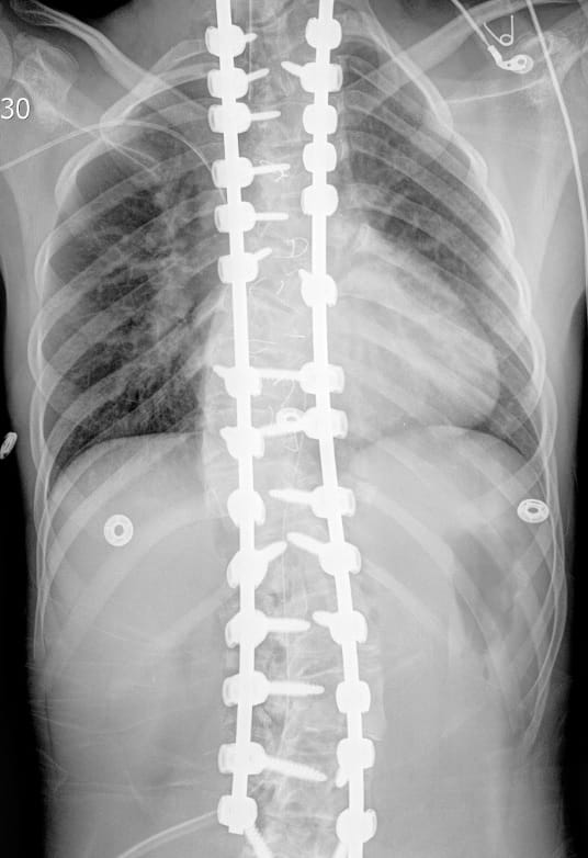 X-ray of spine after procedure