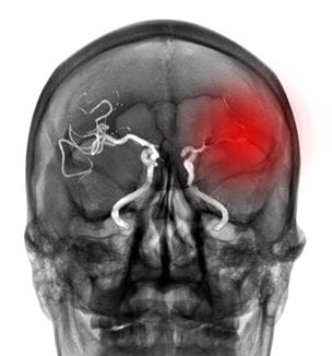 Getty image illustrating brain aneurysm