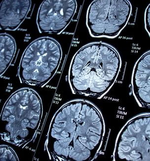 Getty image of MRI of photosenstive epilepsy