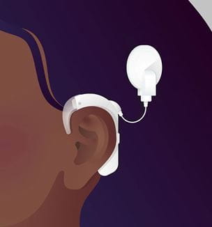Cochlear implant illustration