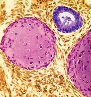Getty image of testicular cancer cell