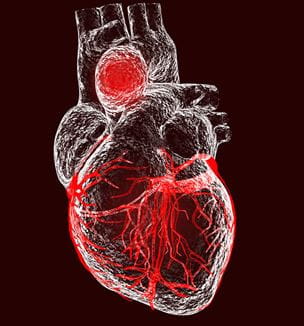 Getty aortic aneurysm illustration